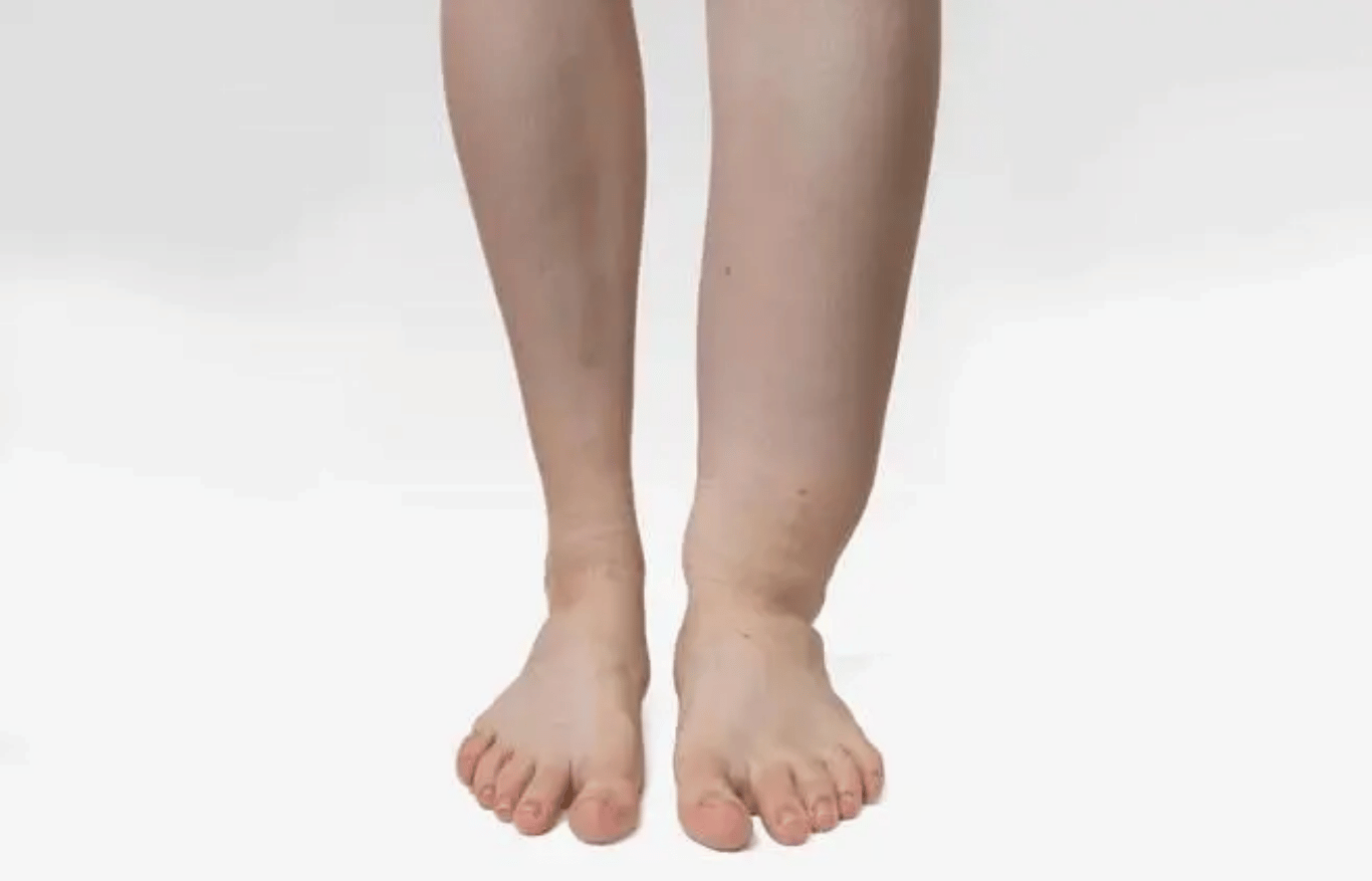 Geschwollene Beine und Füße als sichtbares Zeichen eines Lymphödems an den unteren Extremitäten
