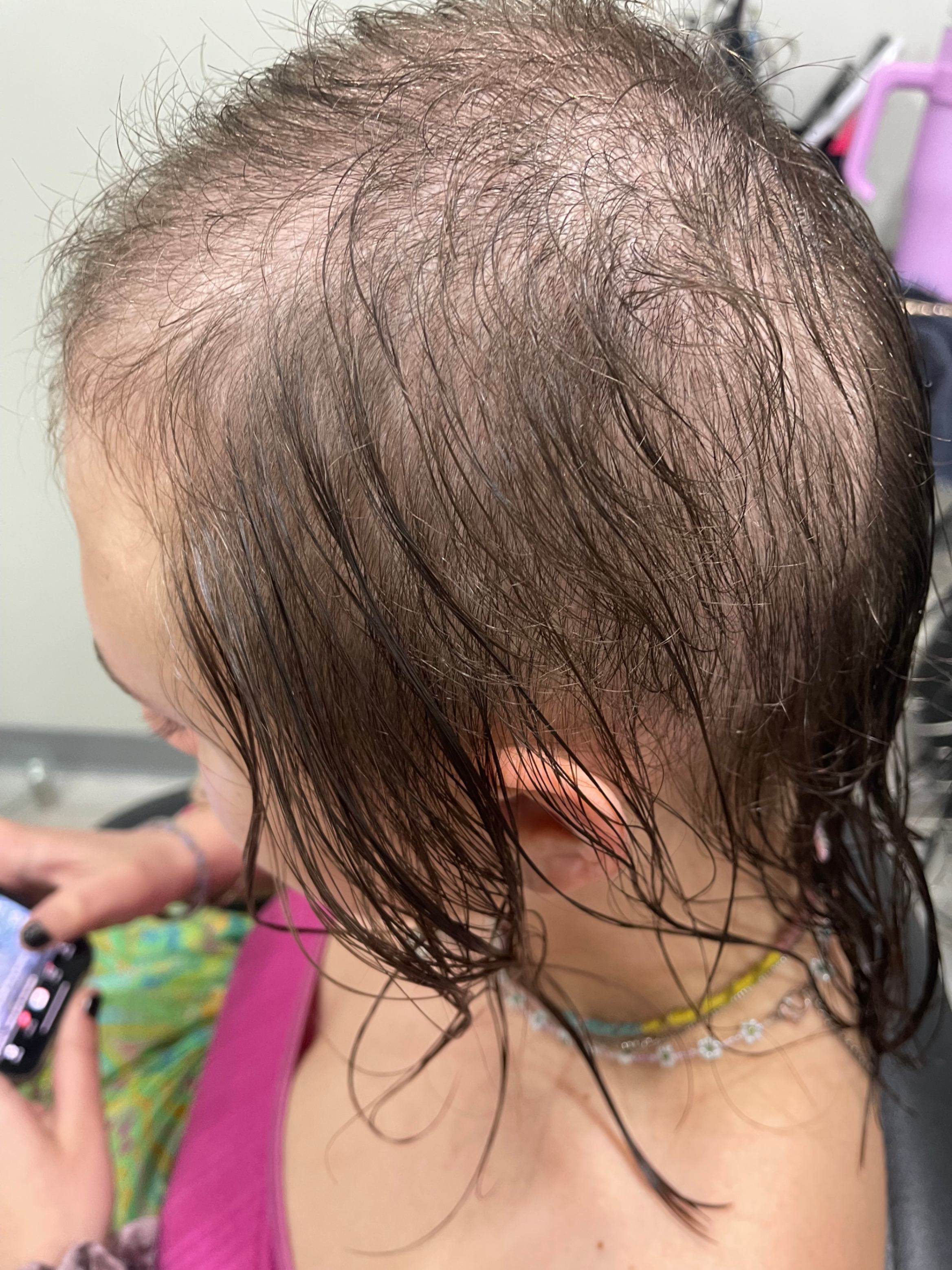 trichotillomania hair loss due to hair pulling
