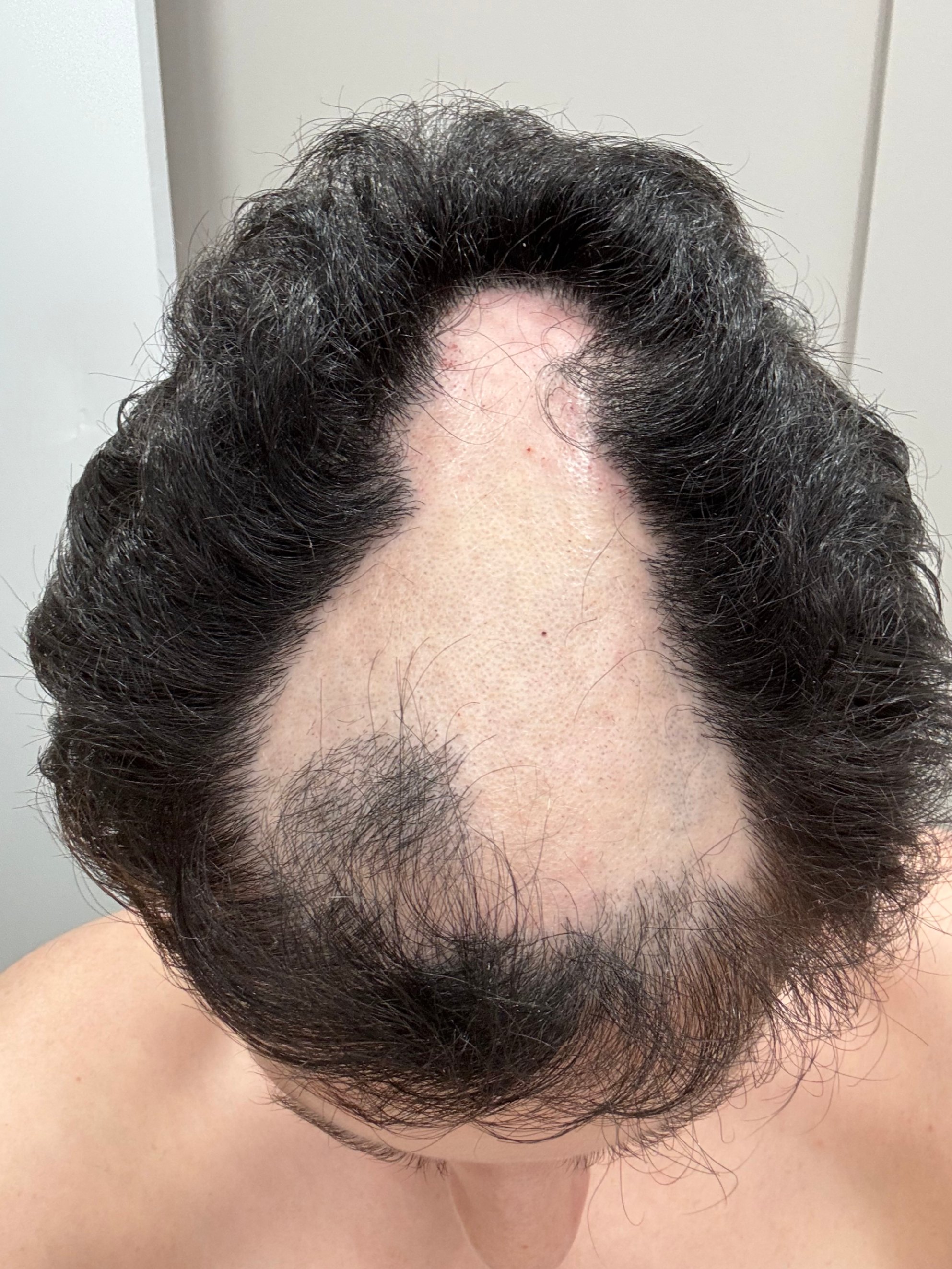 a person with trichotillomania