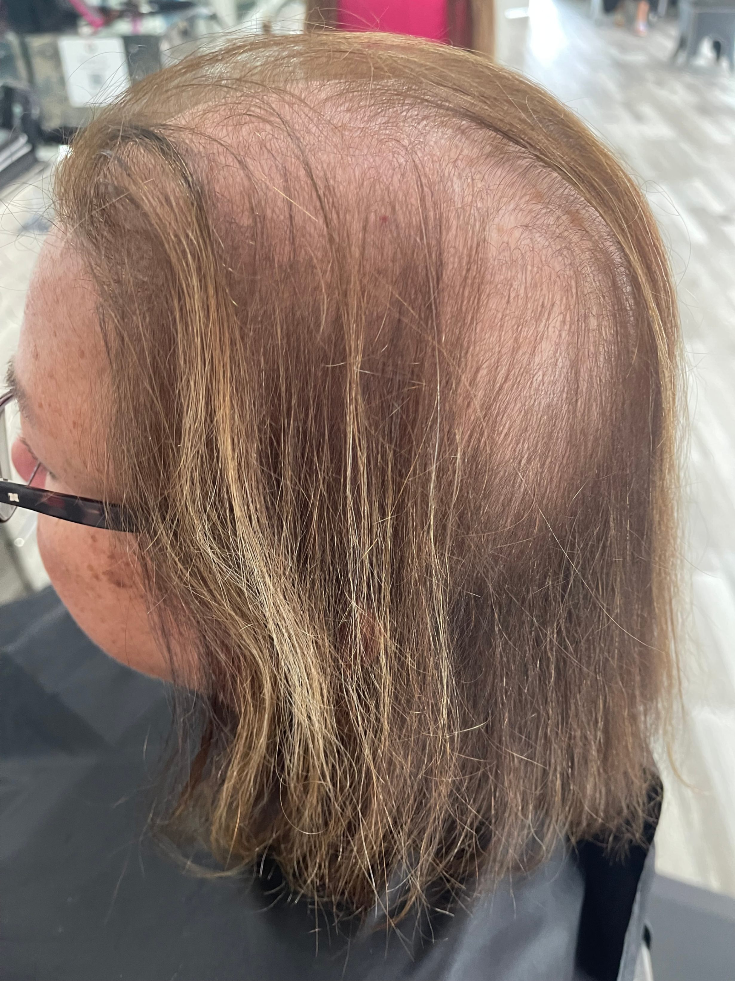 stress inuced hair loss